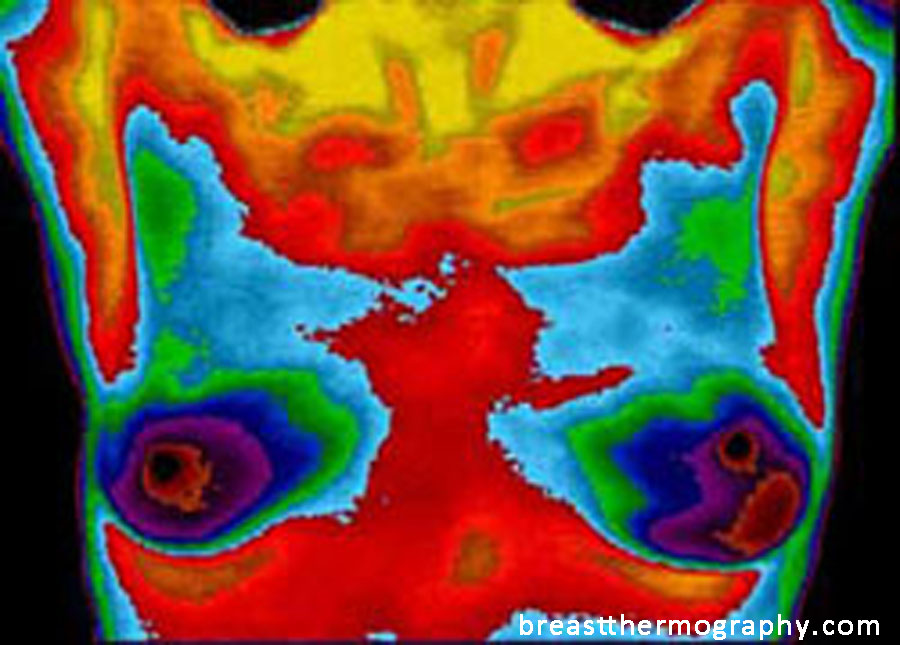 Thermography for breast cancer prevention