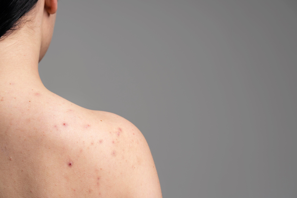 The Acne Remedy: From Diet to Skincare Routine - Image of a bare shoulder with some acne present