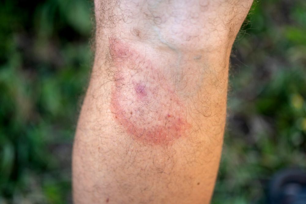 Lyme disease rash on persons forearm